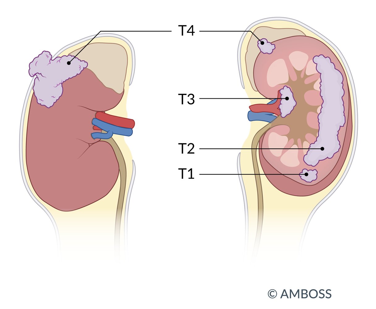 Renal cell carcinoma: tumor stages