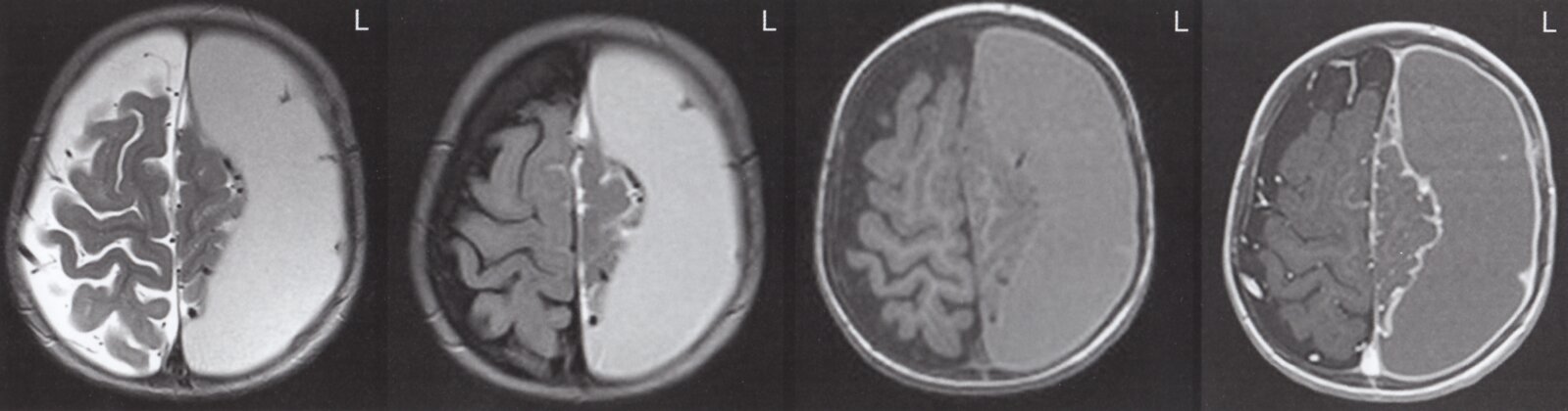 Subdural hematoma