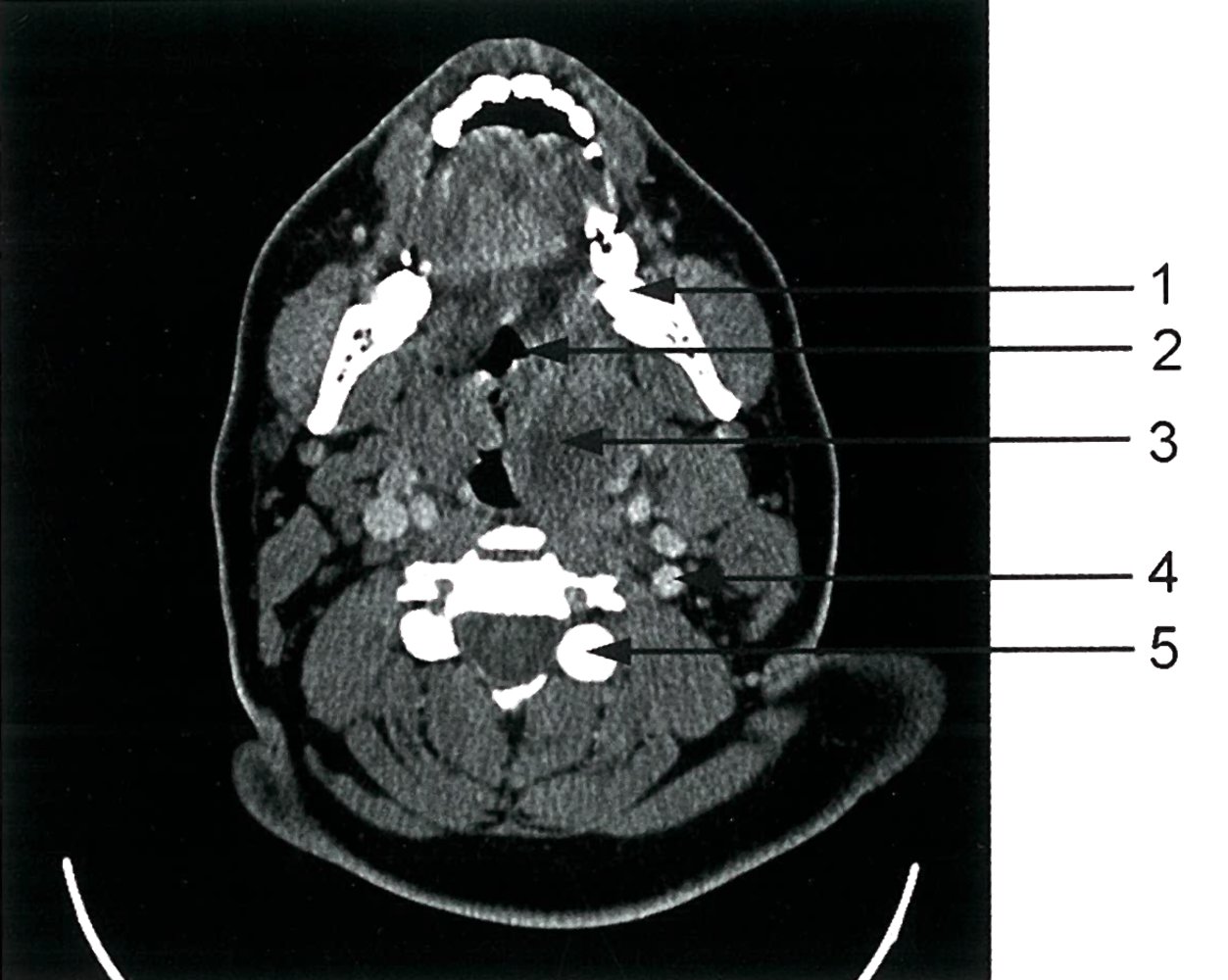 Peritonsillar mass