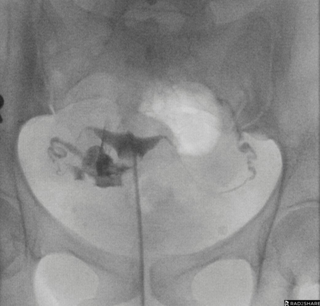 Normal hysterosalpingogram
