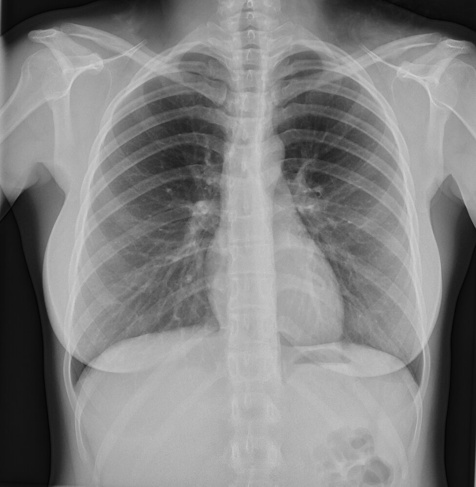 Normal posteroanterior (PA) chest radiograph - pulmonary vessels