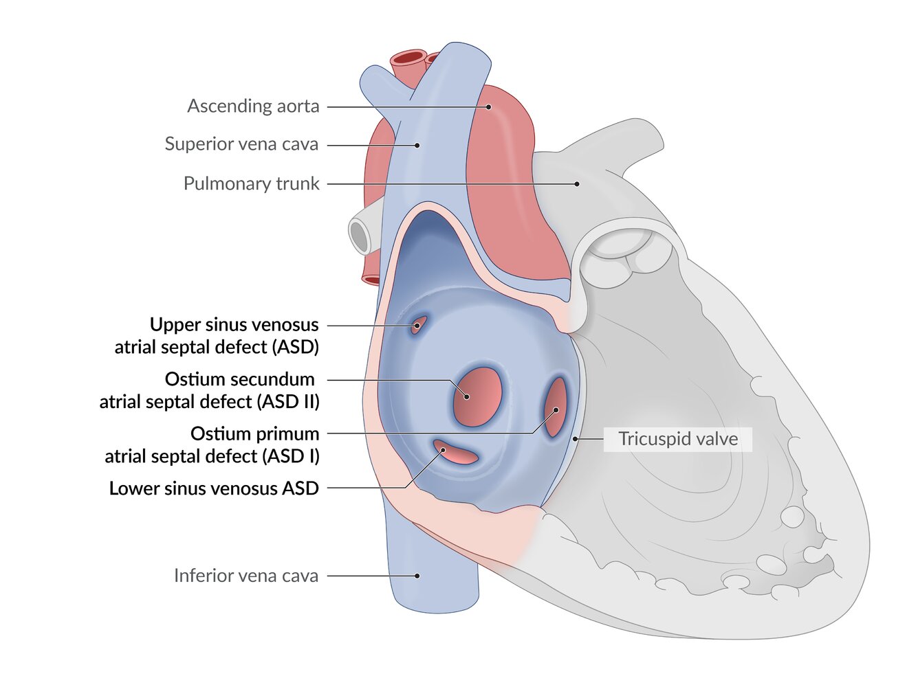 Types of atrial septal defects