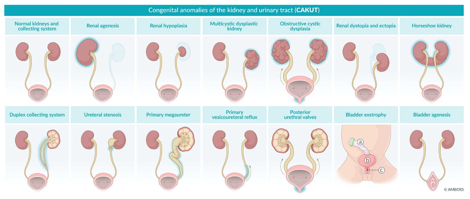 Congenital anomalies of the kidneys and urinary tract (CAKUT)