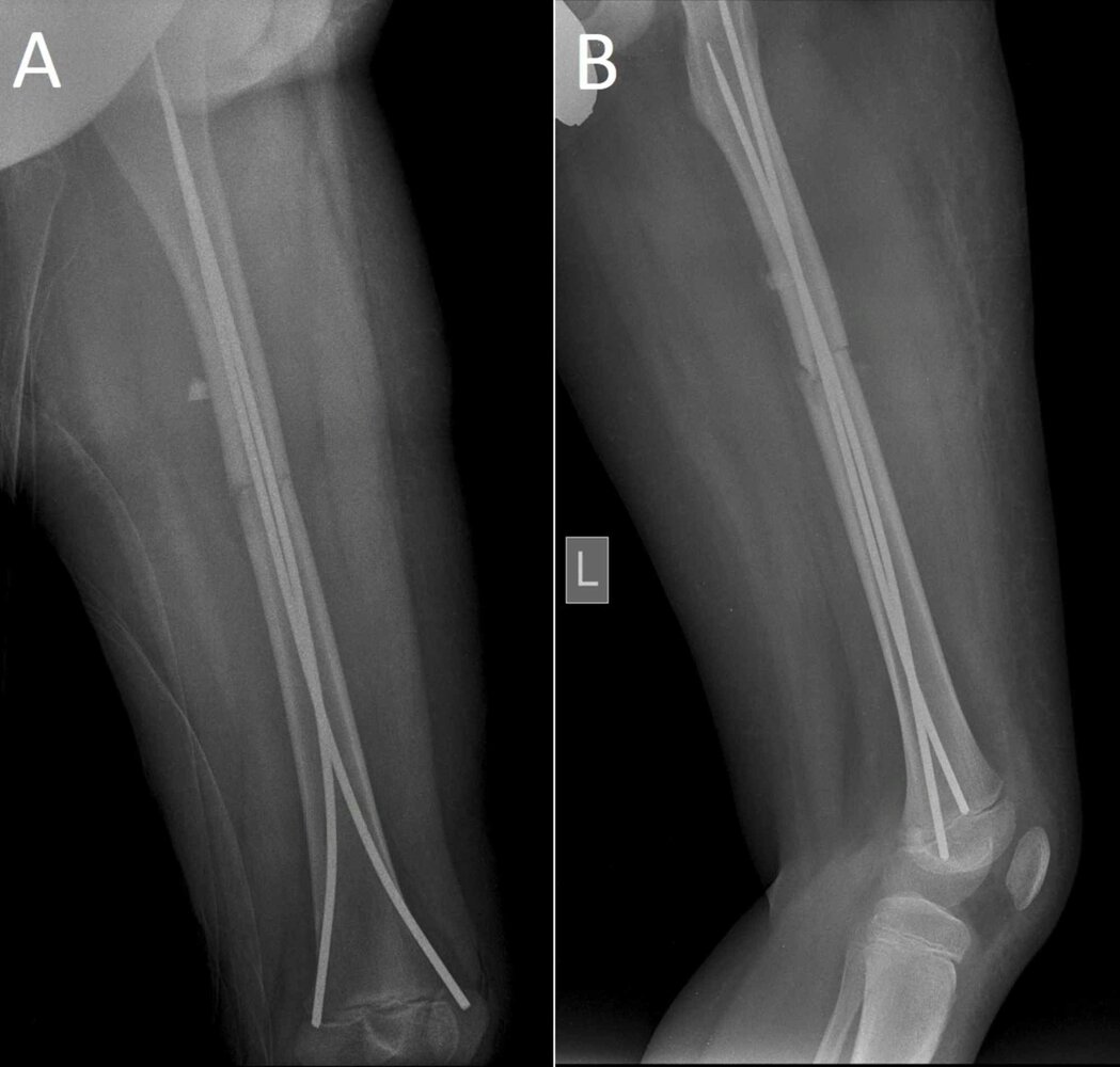 Acute femoral fracture in a child 2/2
