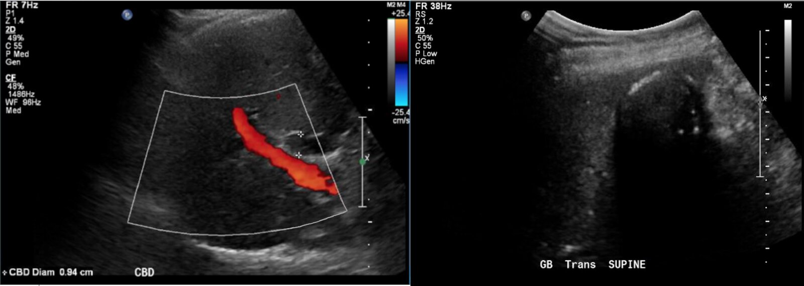 Porcelain gallbladder