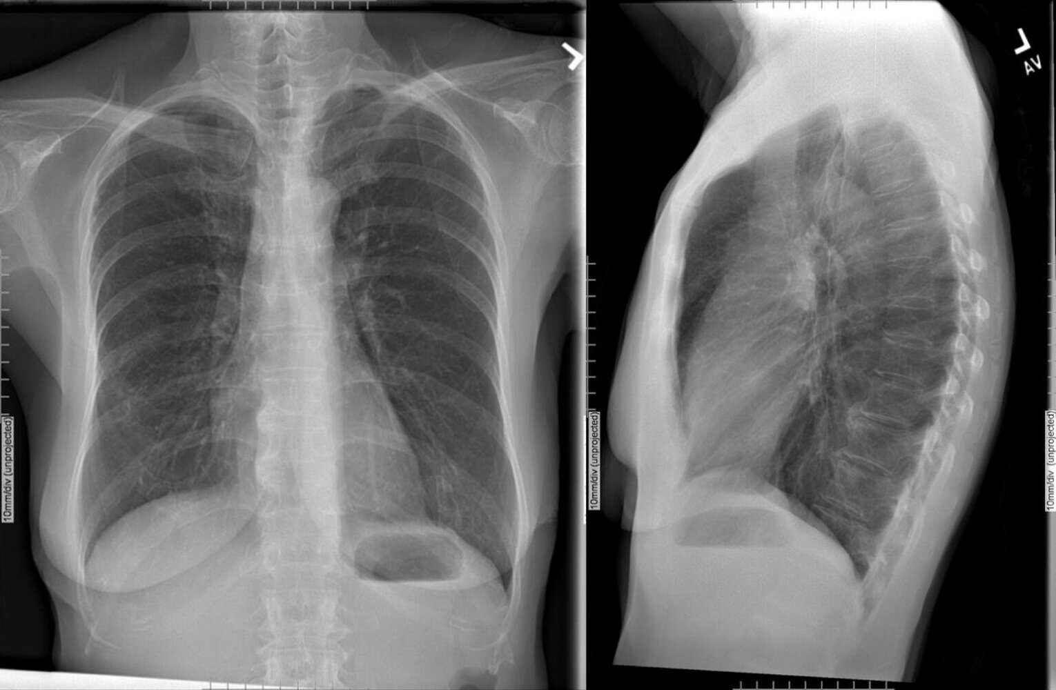 Hyperinflation in COPD