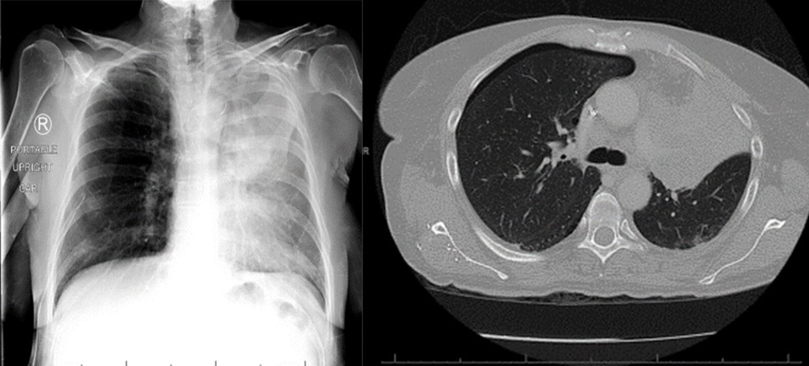 Central mass with left upper lobe collapse and luftsichel sign