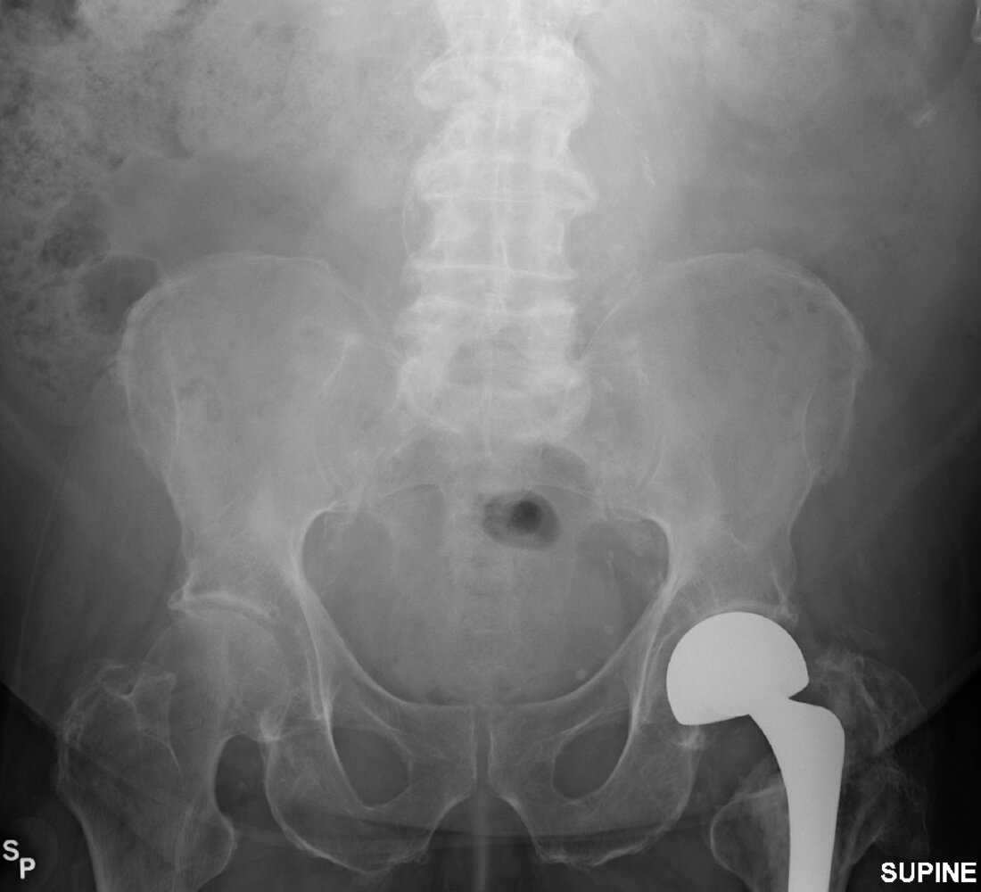 Abdominal aortic aneurysm