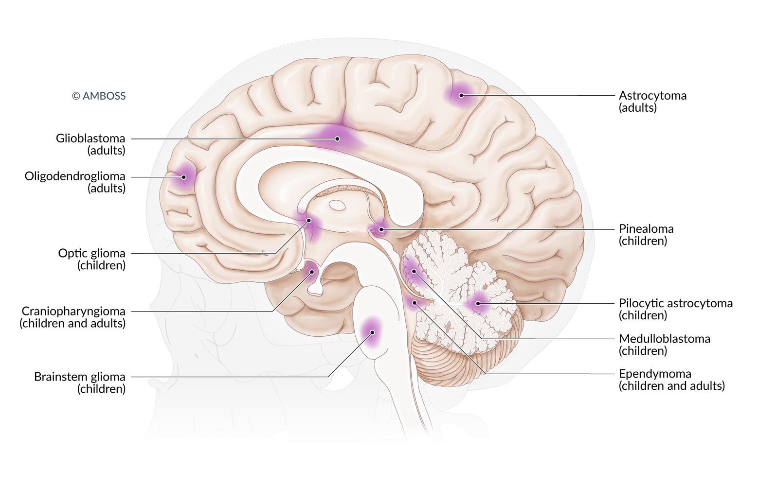Typical locations of brain tumors