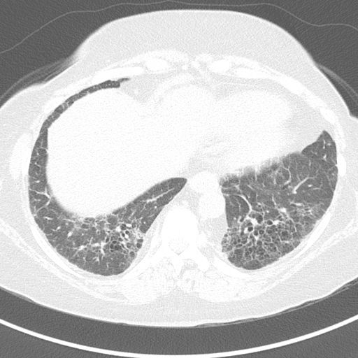 Rheumatoid-associated interstitial lung disease (RA-ILD)