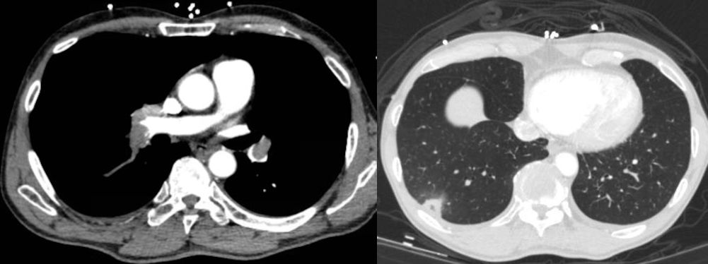 Pulmonary embolism with infarction