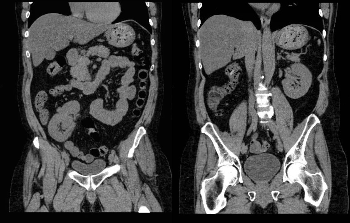Pelvic kidney