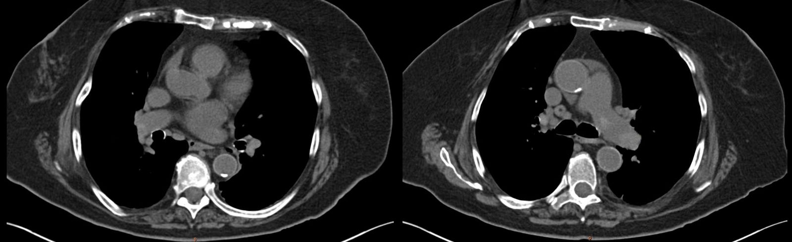 Pulmonary embolism
