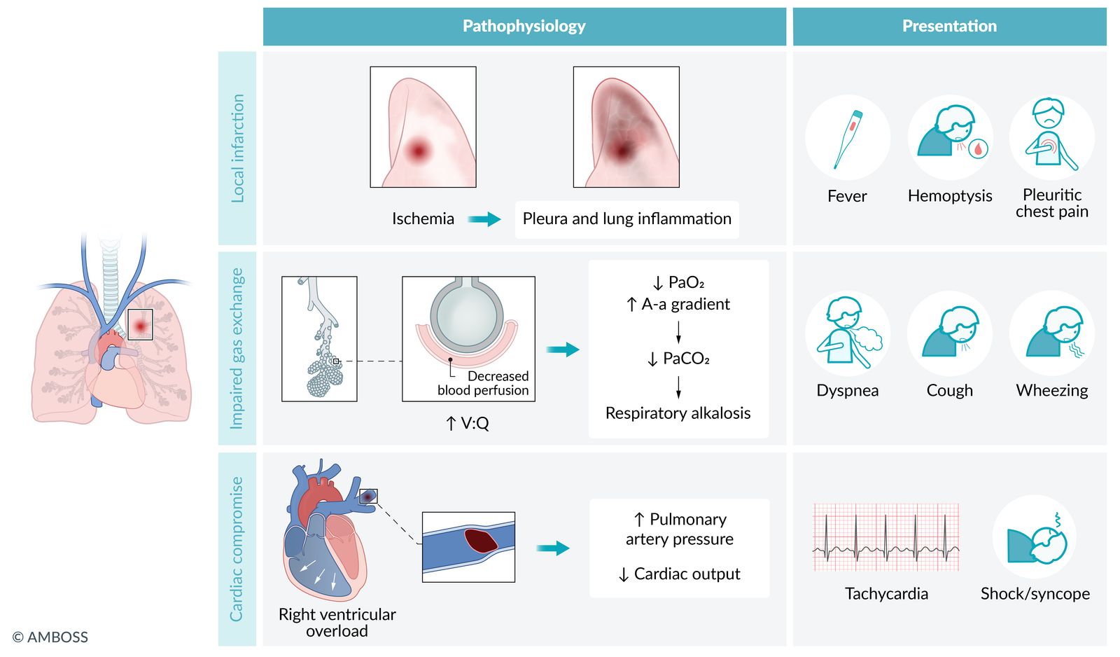 Pulmonary embolism: pathophysiologic response of the lung