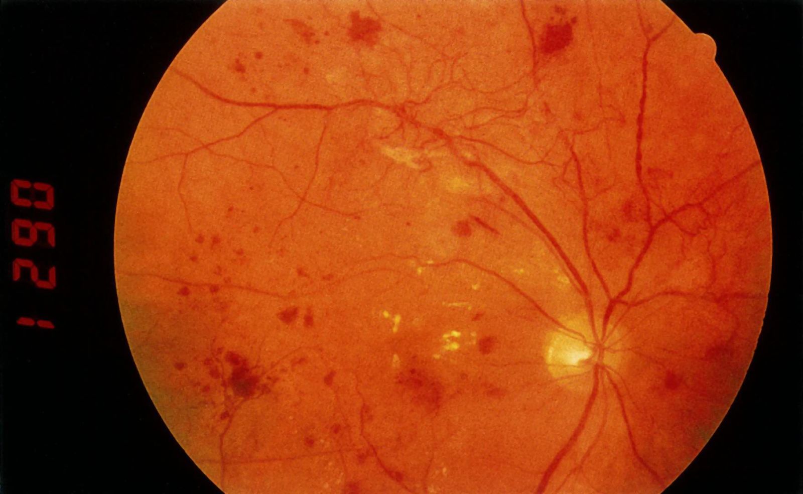 Proliferative diabetic retinopathy
