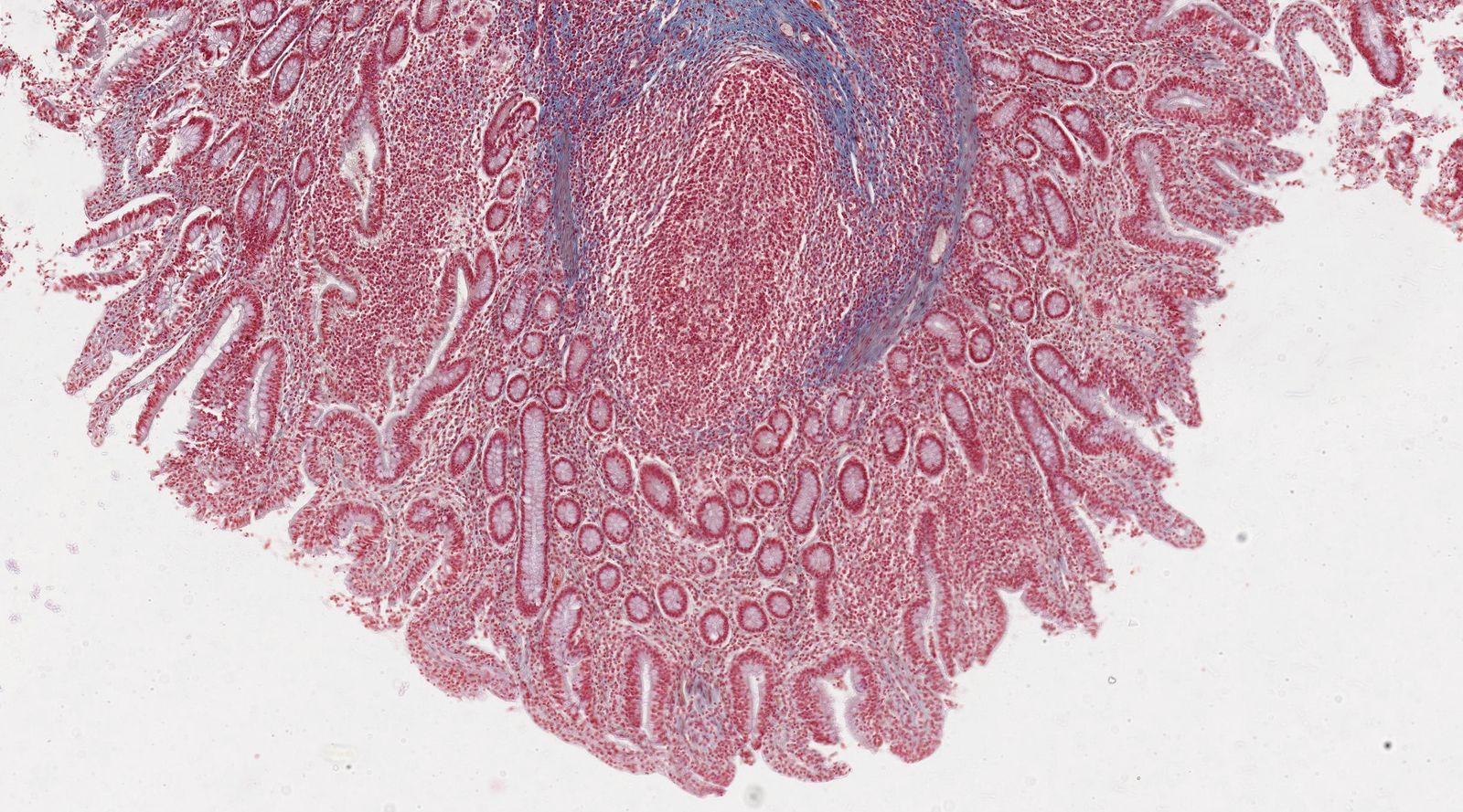 Peyer patches