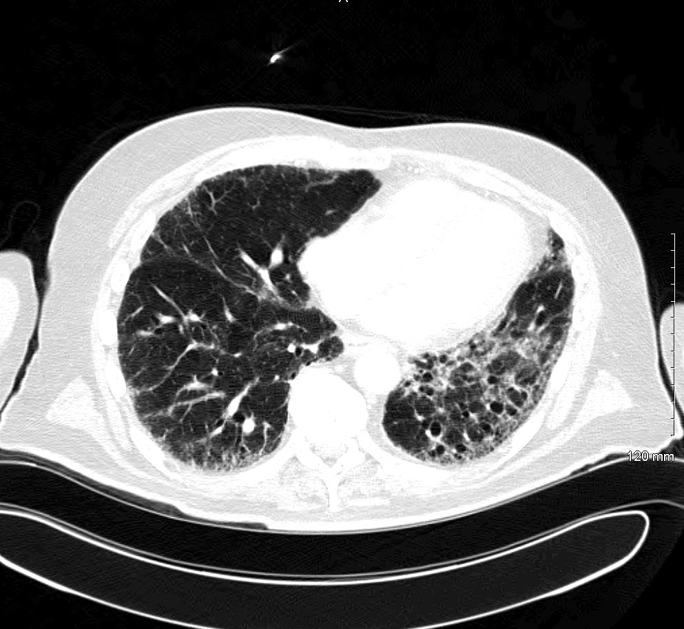 Chronic interstitial lung disease