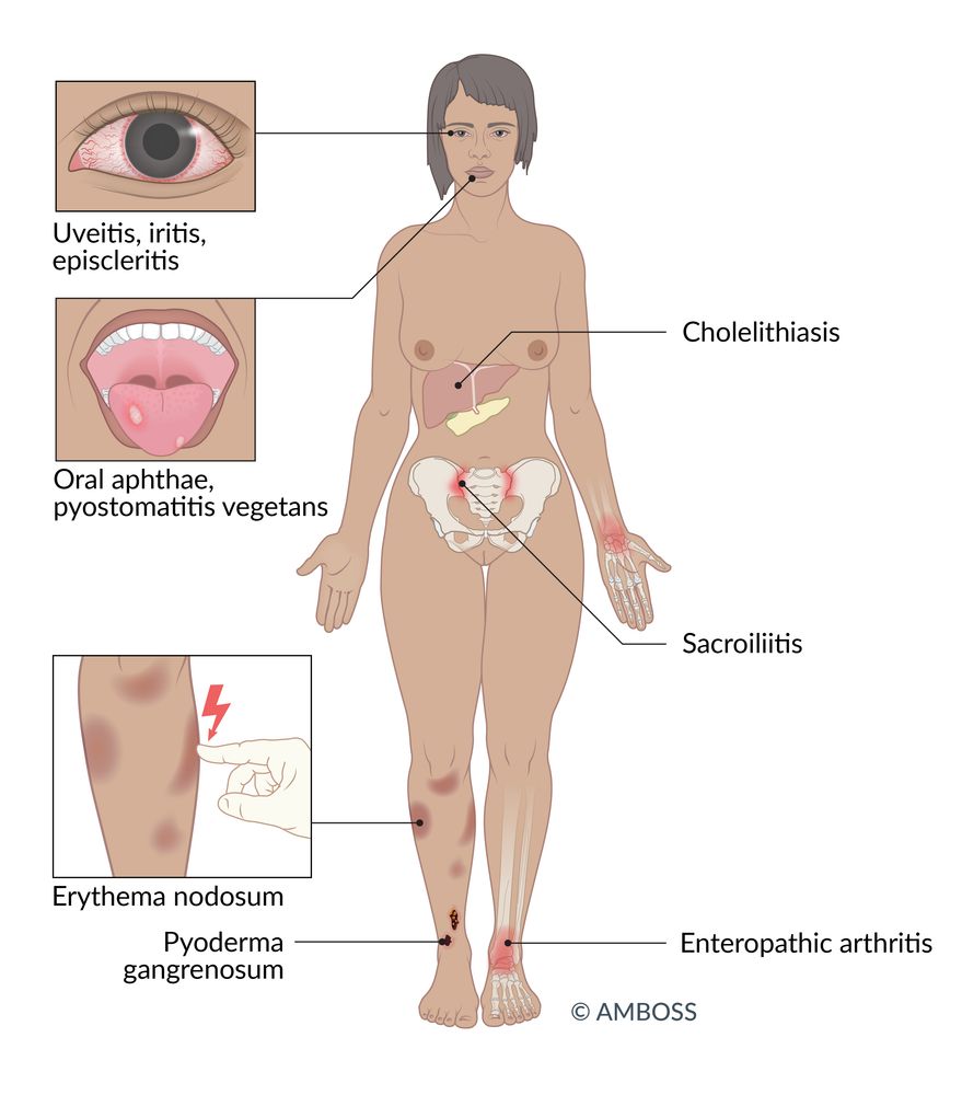 Extraintestinal manifestations of inflammatory bowel disease