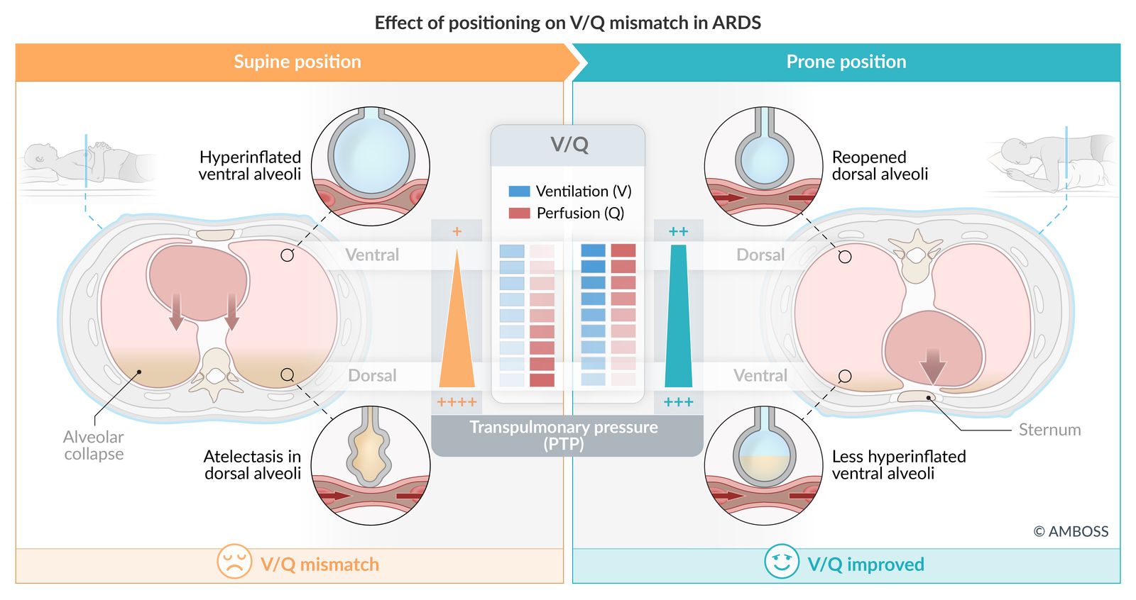 Effect of positioning on V/Q mismatch: ARDS