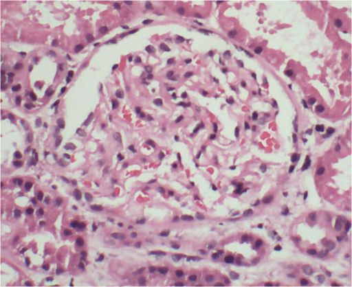 Minimal change disease