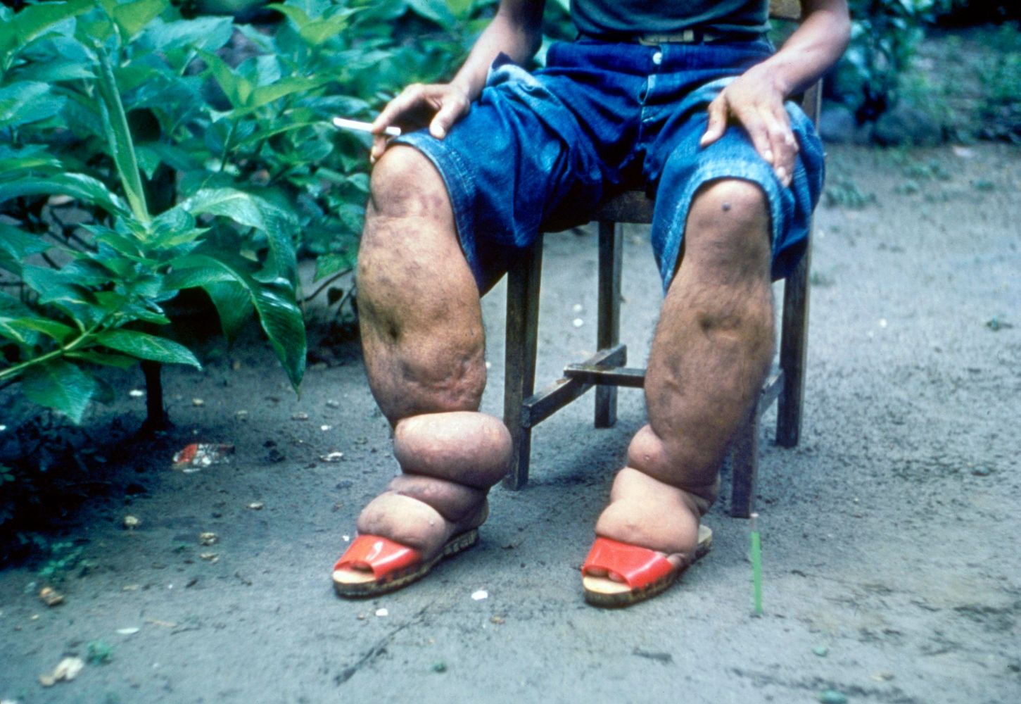 Elephantiasis from lymphatic filariasis