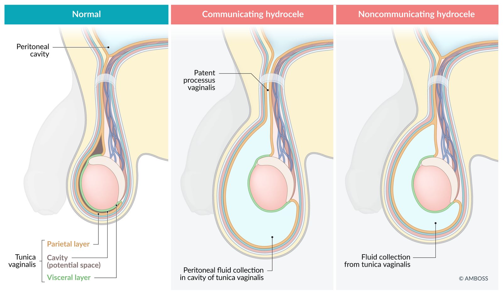 Hydrocele
