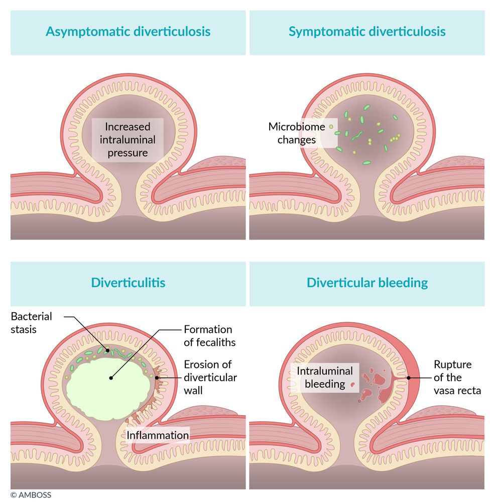 Types of diverticular disease