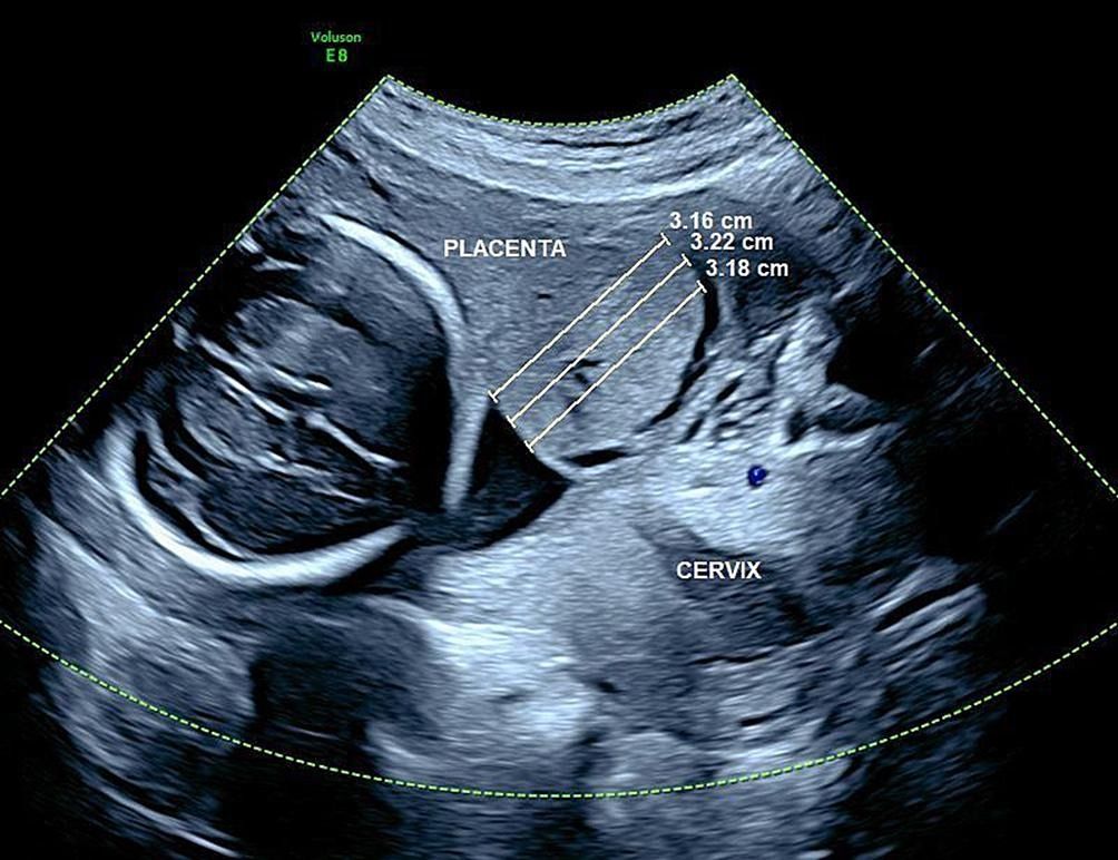 Complete placenta previa