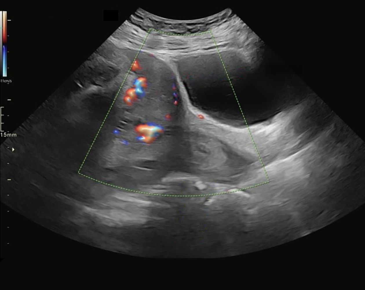 Ultrasound of complete placenta previa
