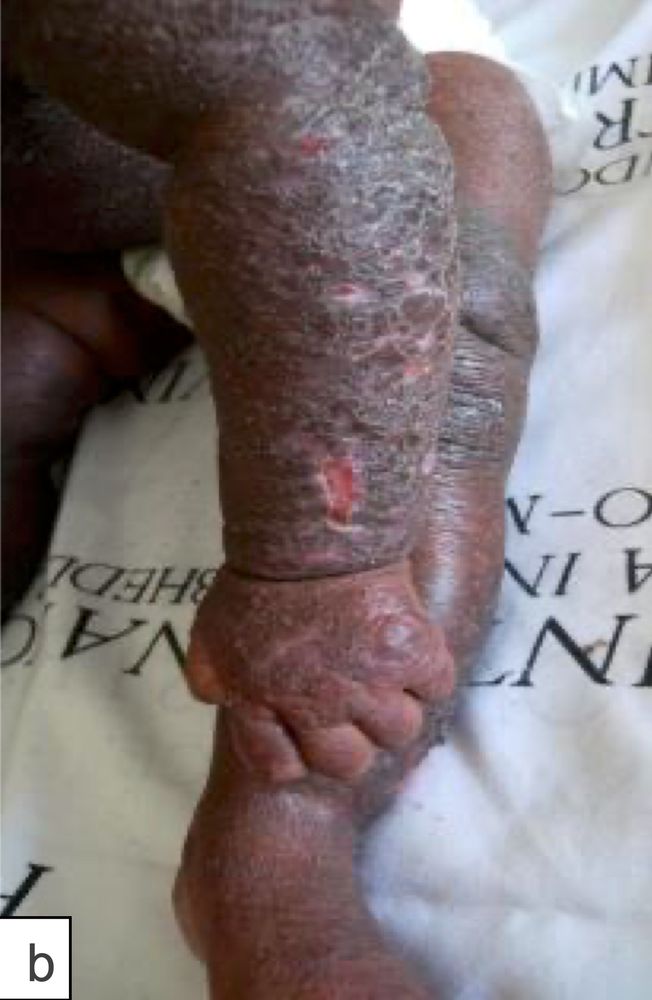 Atopic dermatitis