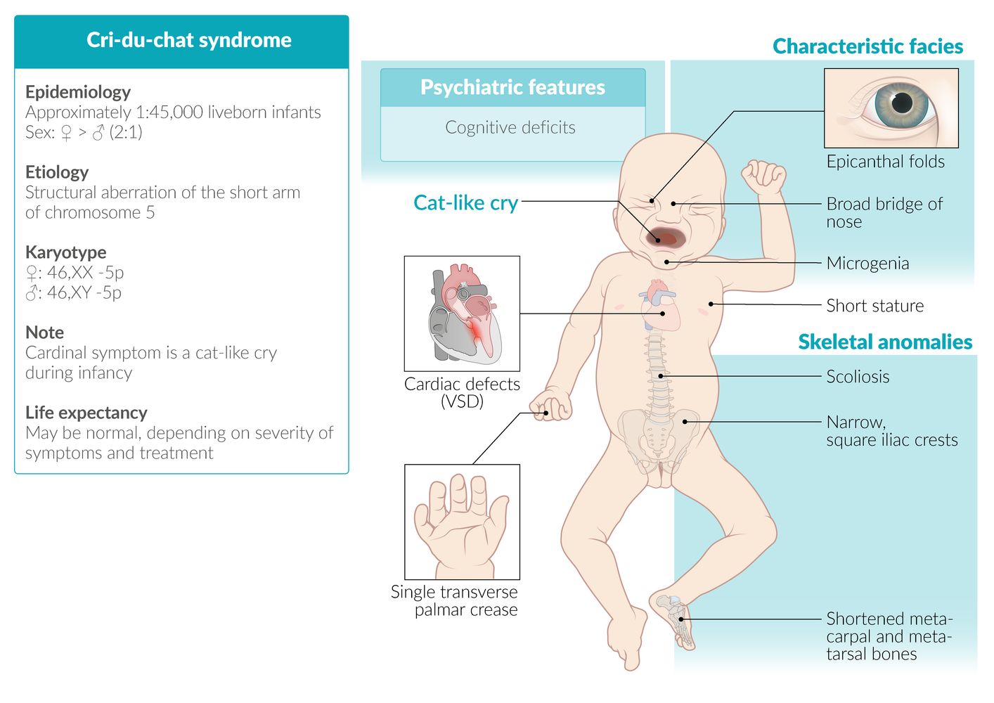 Cri-du-chat syndrome (Cat cry syndrome) fact sheet