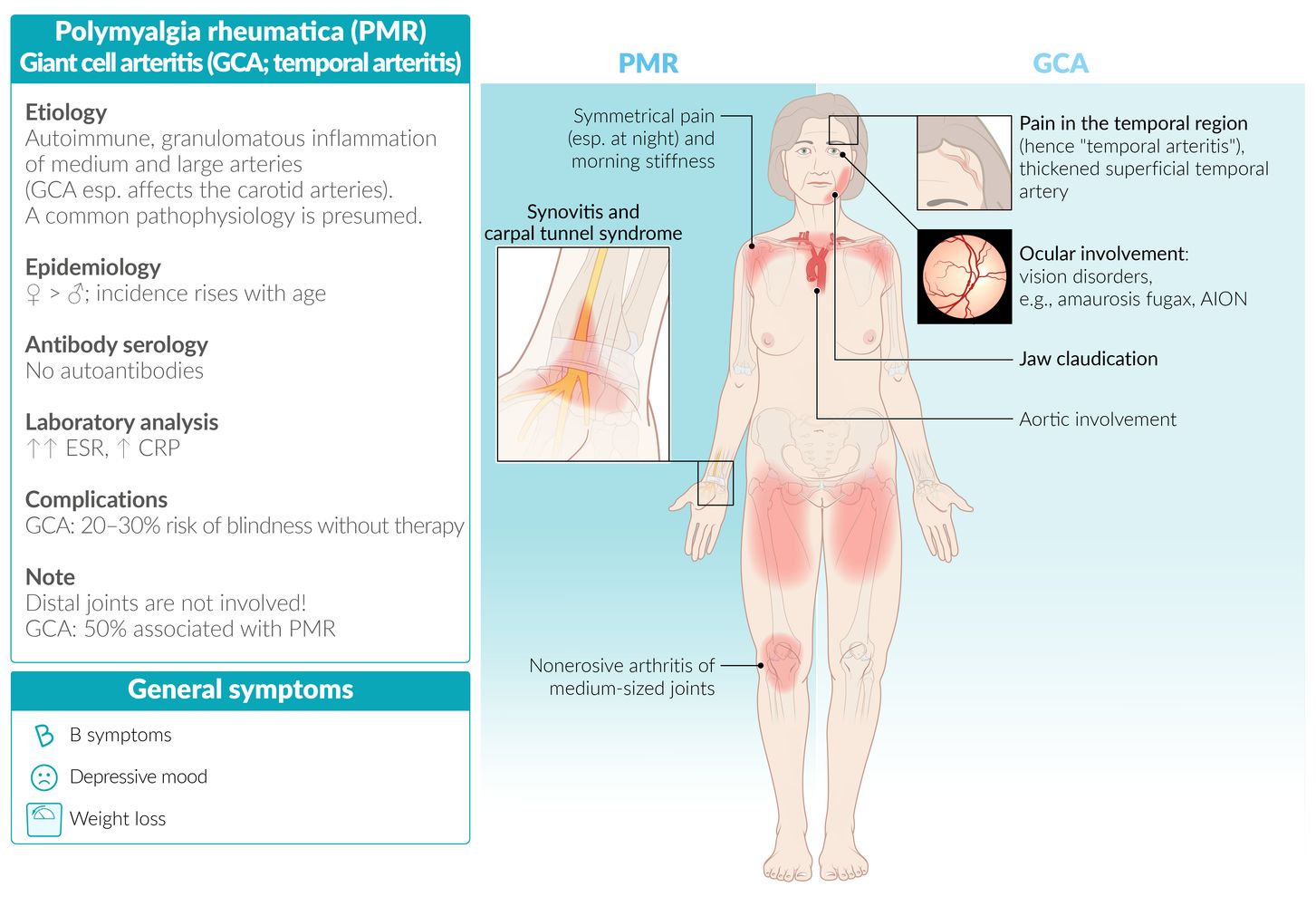 Polymyalgia rheumatica and giant cell arteritis fact sheet