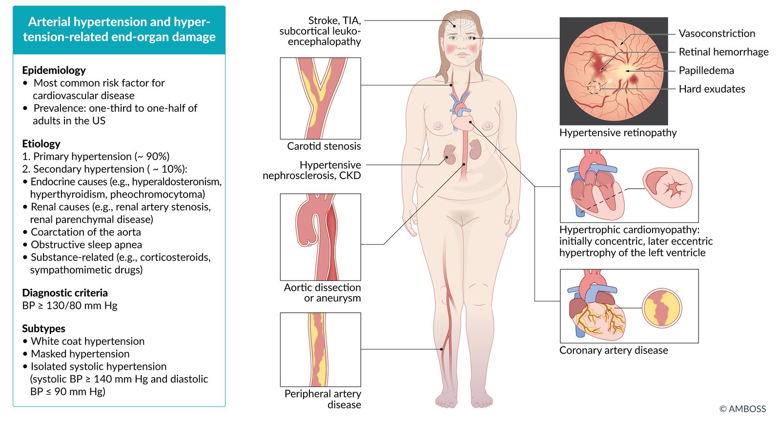 Hypertension fact sheet