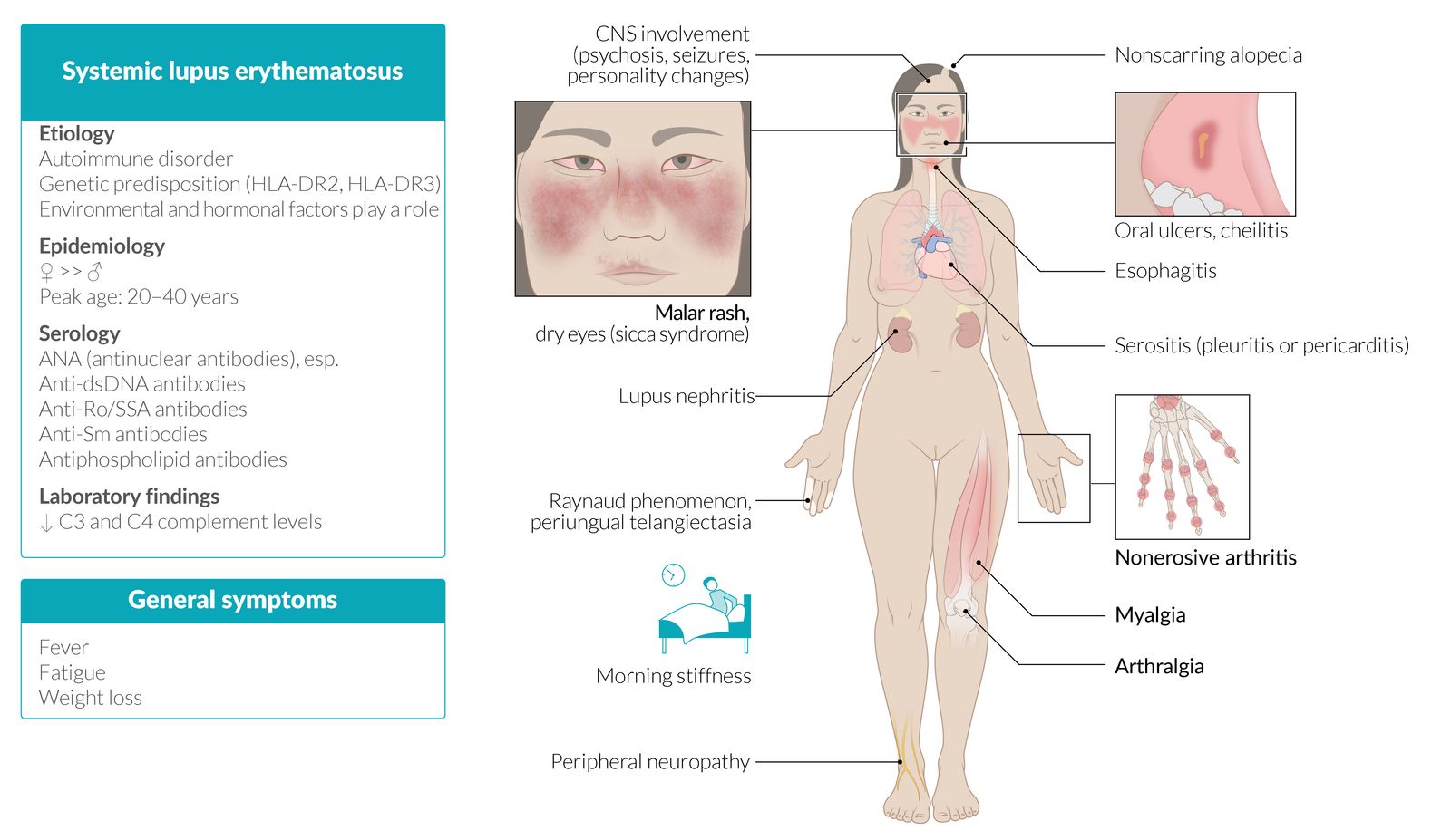 Systemic lupus erythematosus fact sheet