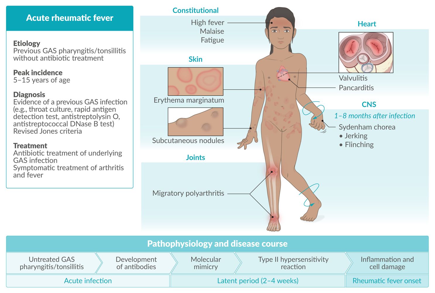 Acute rheumatic fever fact sheet