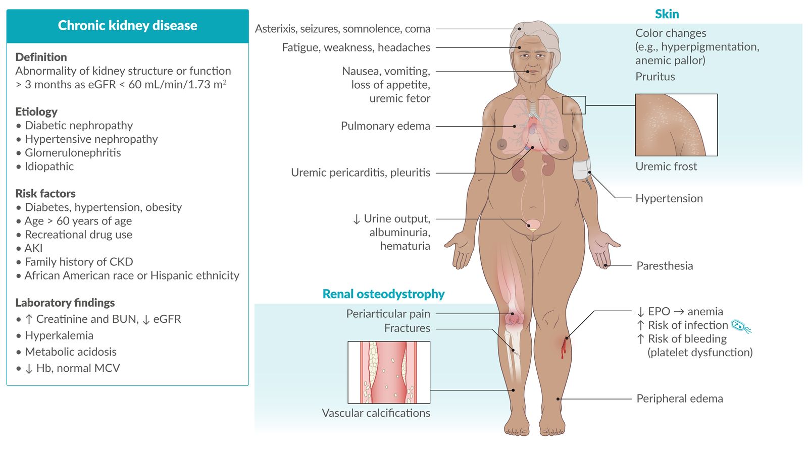 Chronic kidney disease fact sheet