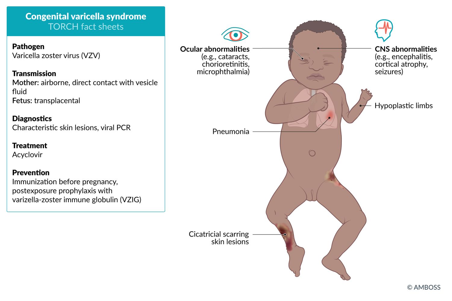 Congenital varicella syndrome TORCH fact sheet