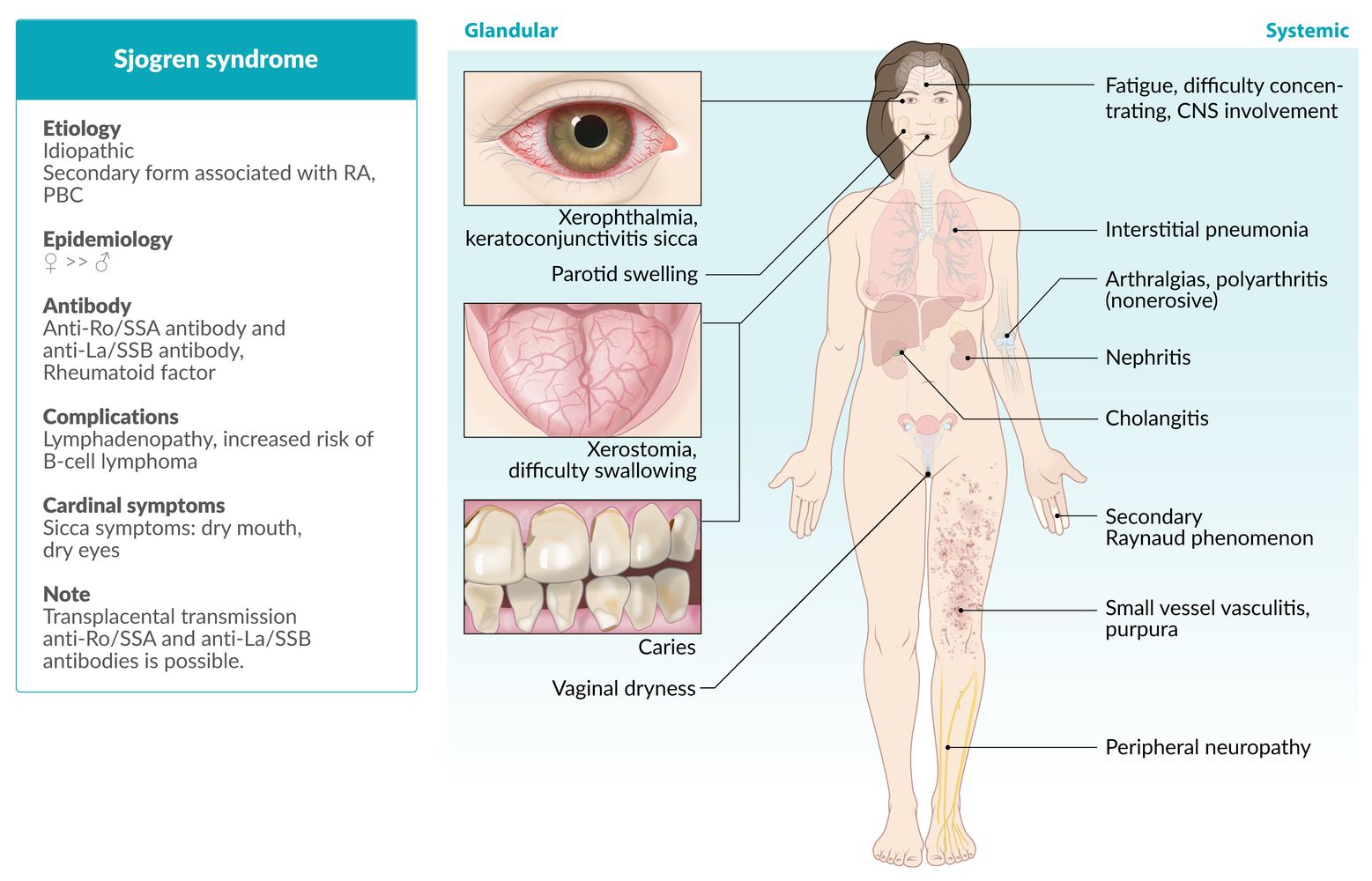 Sjogren syndrome fact sheet