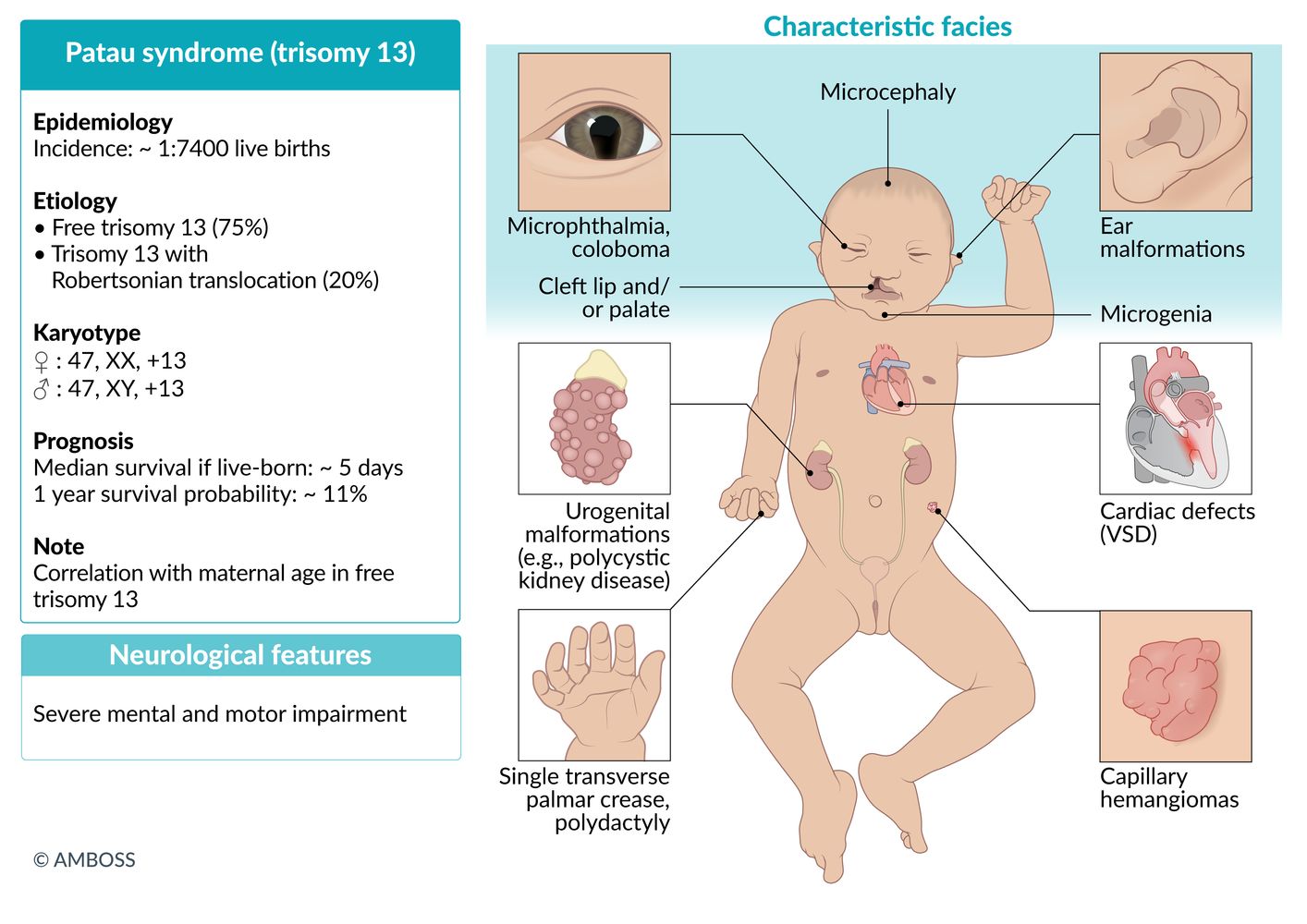 Patau syndrome (trisomy 13) fact sheet