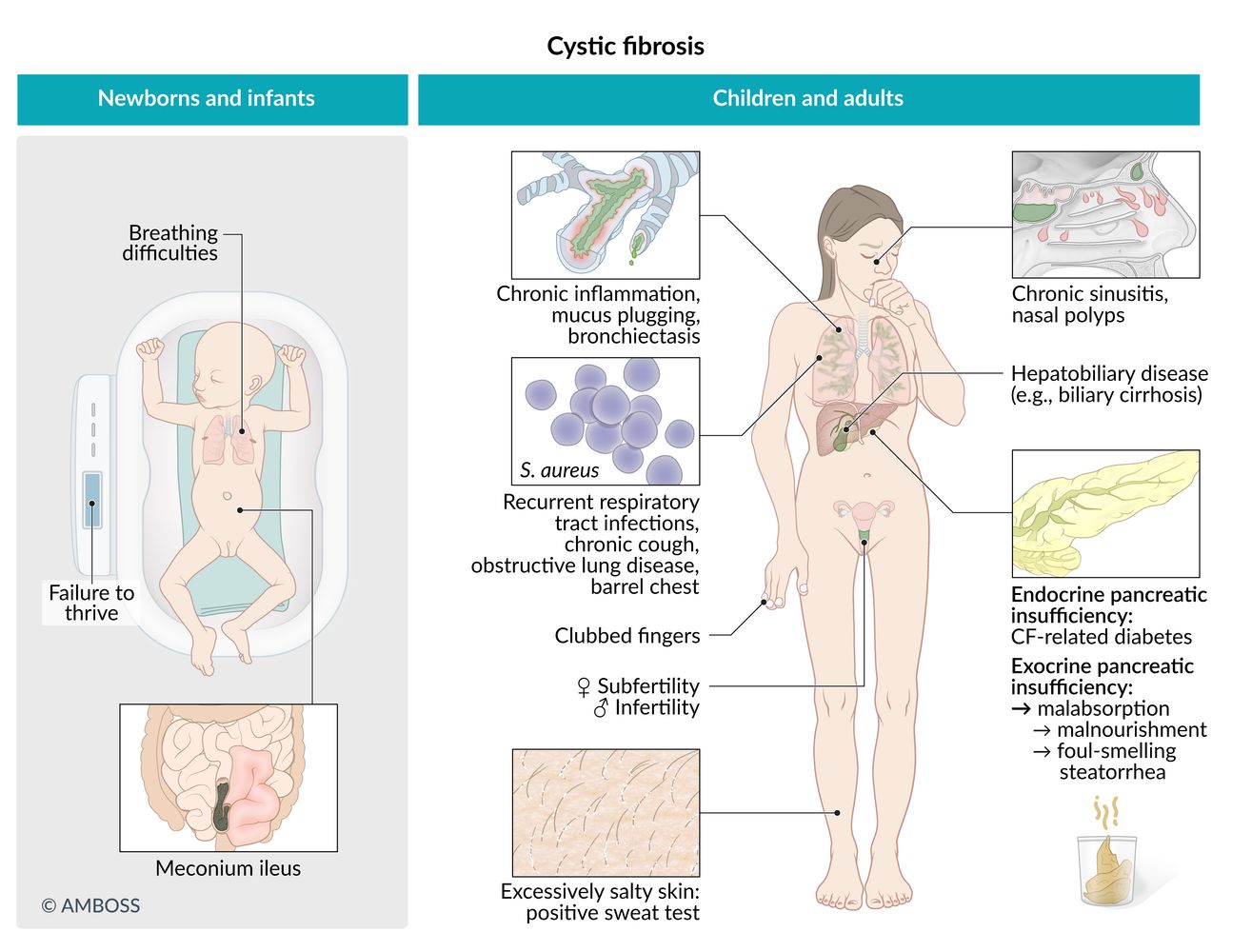 Cystic fibrosis