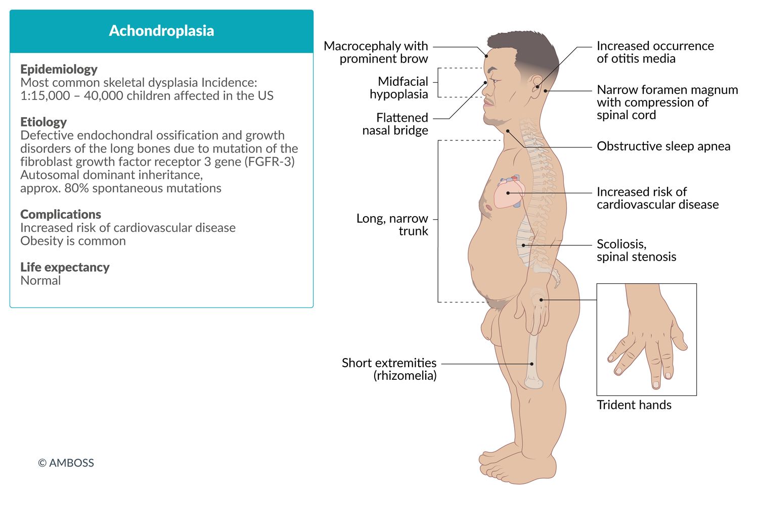 Achondroplasia fact sheet