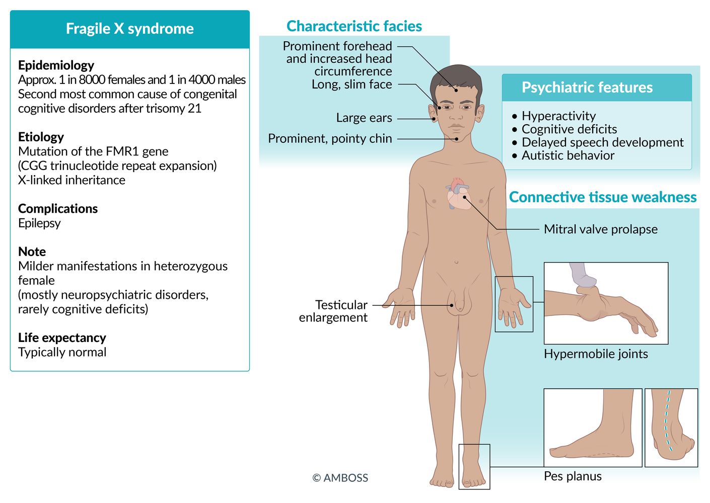 Fragile X syndrome fact sheet