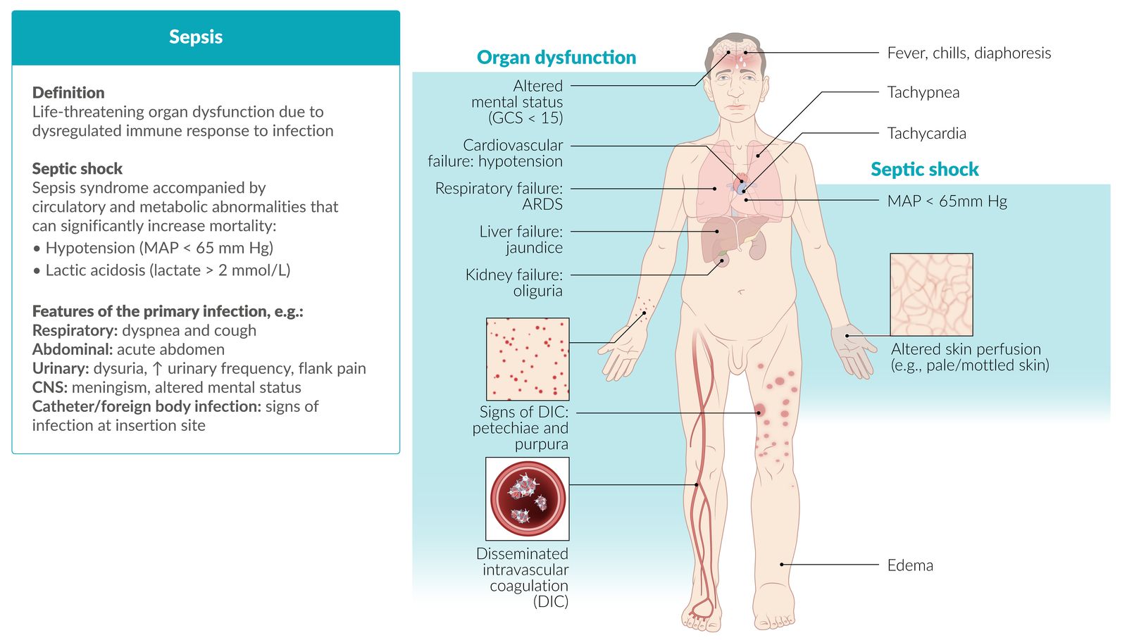 Sepsis fact sheet