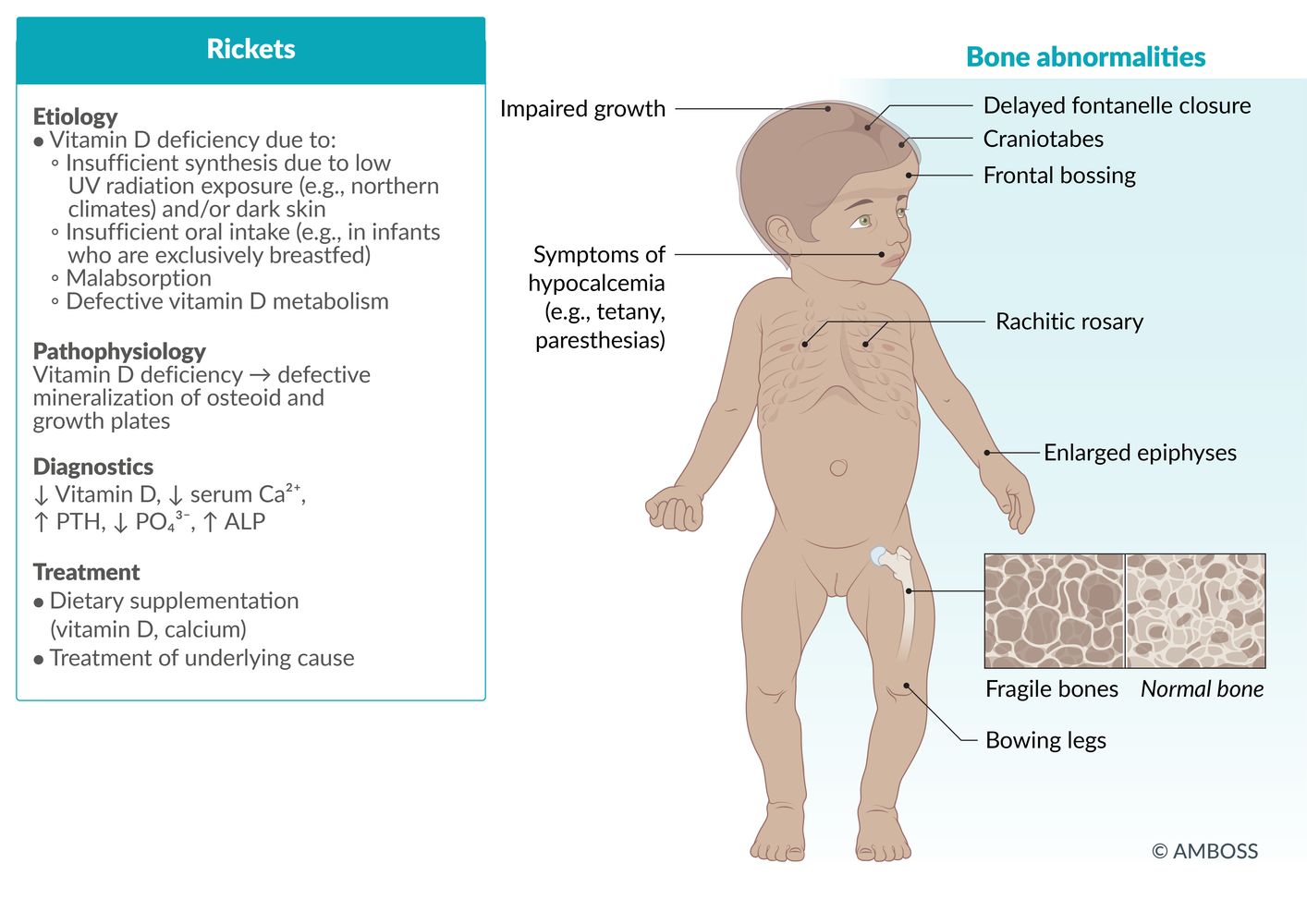Rickets secondary to vitamin D deficiency fact sheet