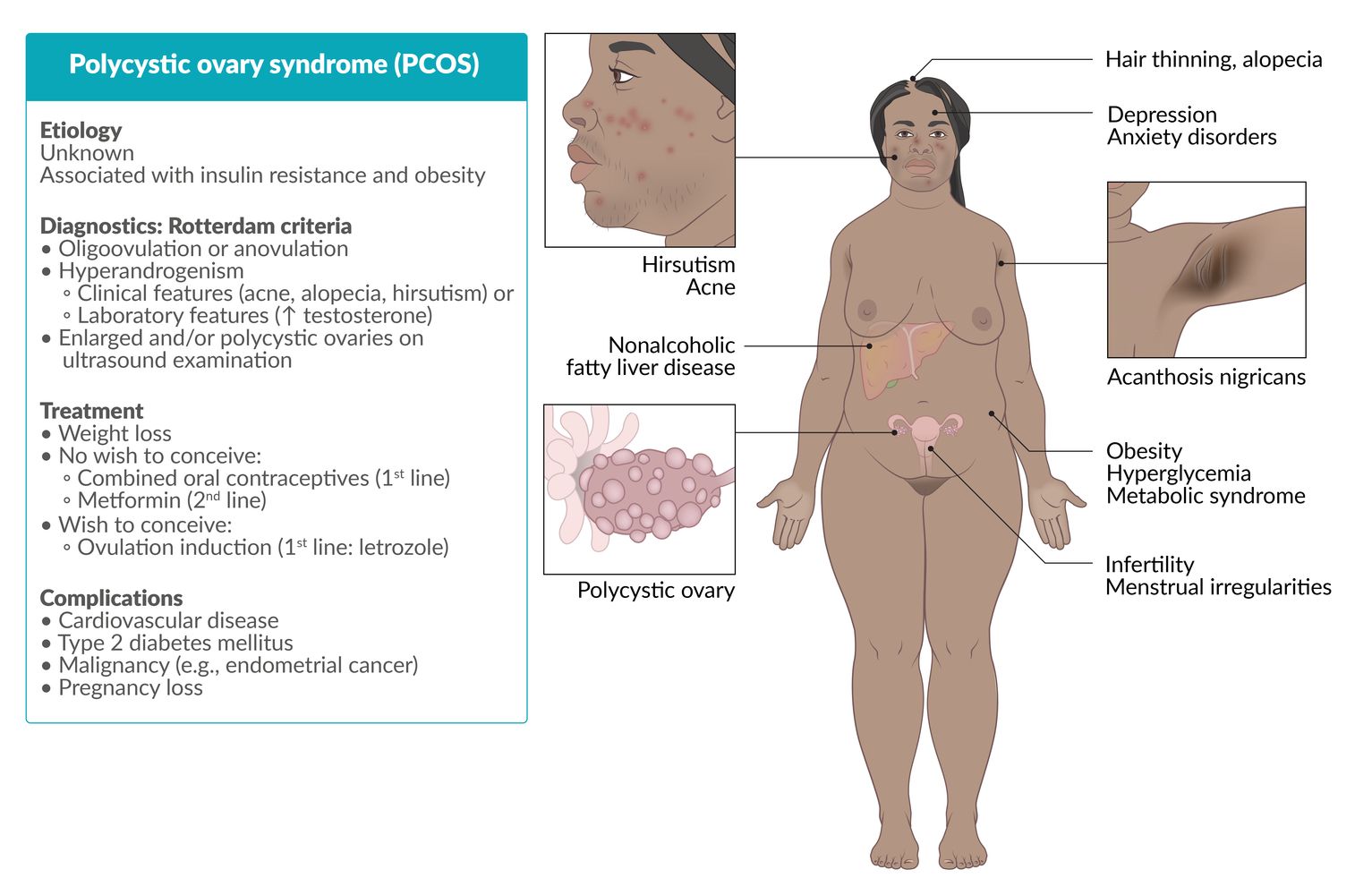 Polycystic ovary syndrome (PCOS) fact sheet