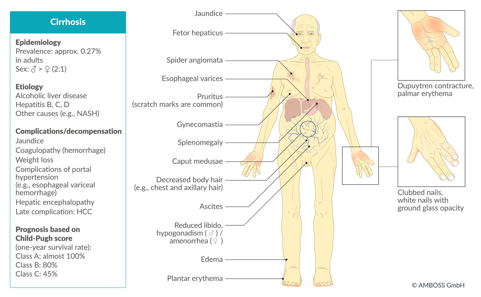 Cirrhosis fact sheet