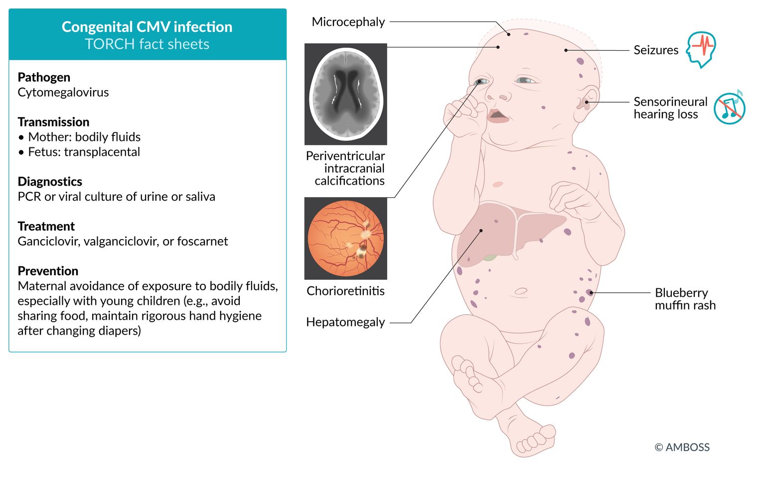 Congenital CMV infection TORCH fact sheet