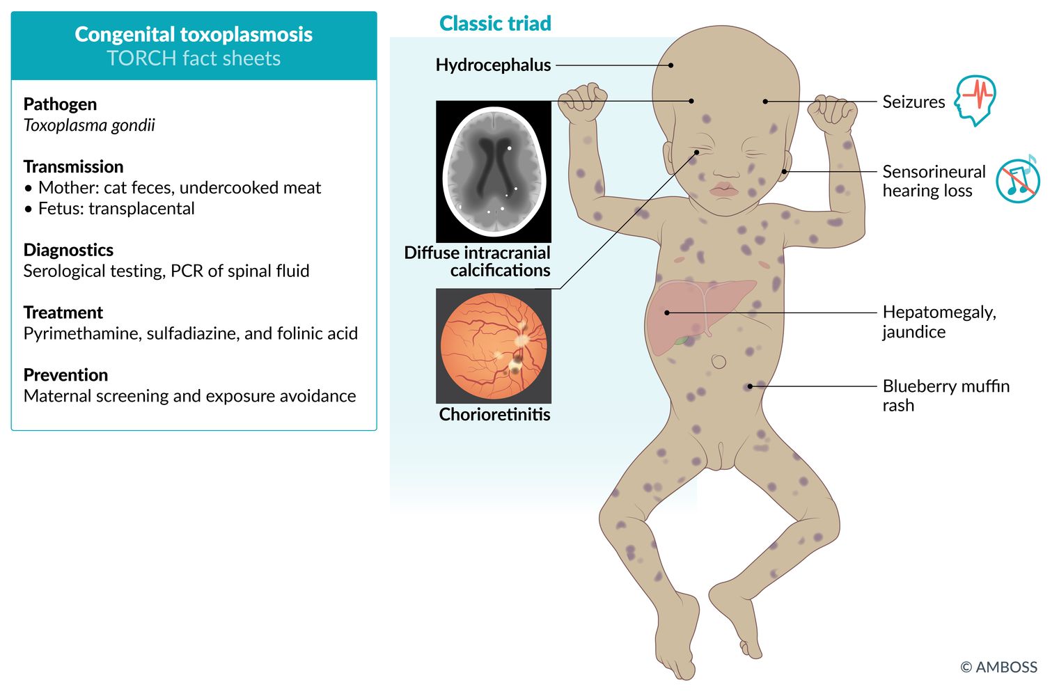 Congenital toxoplasmosis TORCH fact sheet