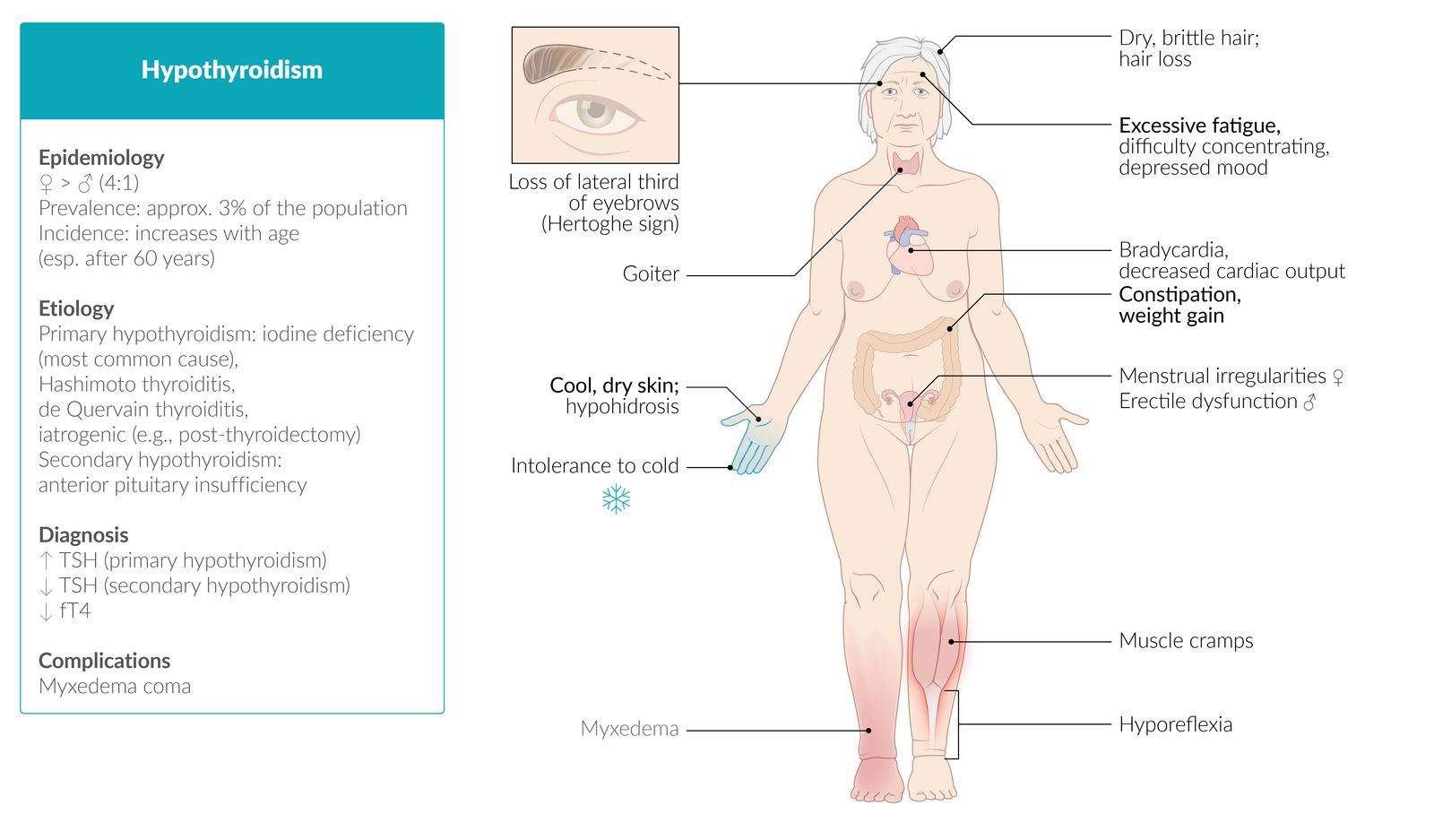 Hypothyroidism fact sheet