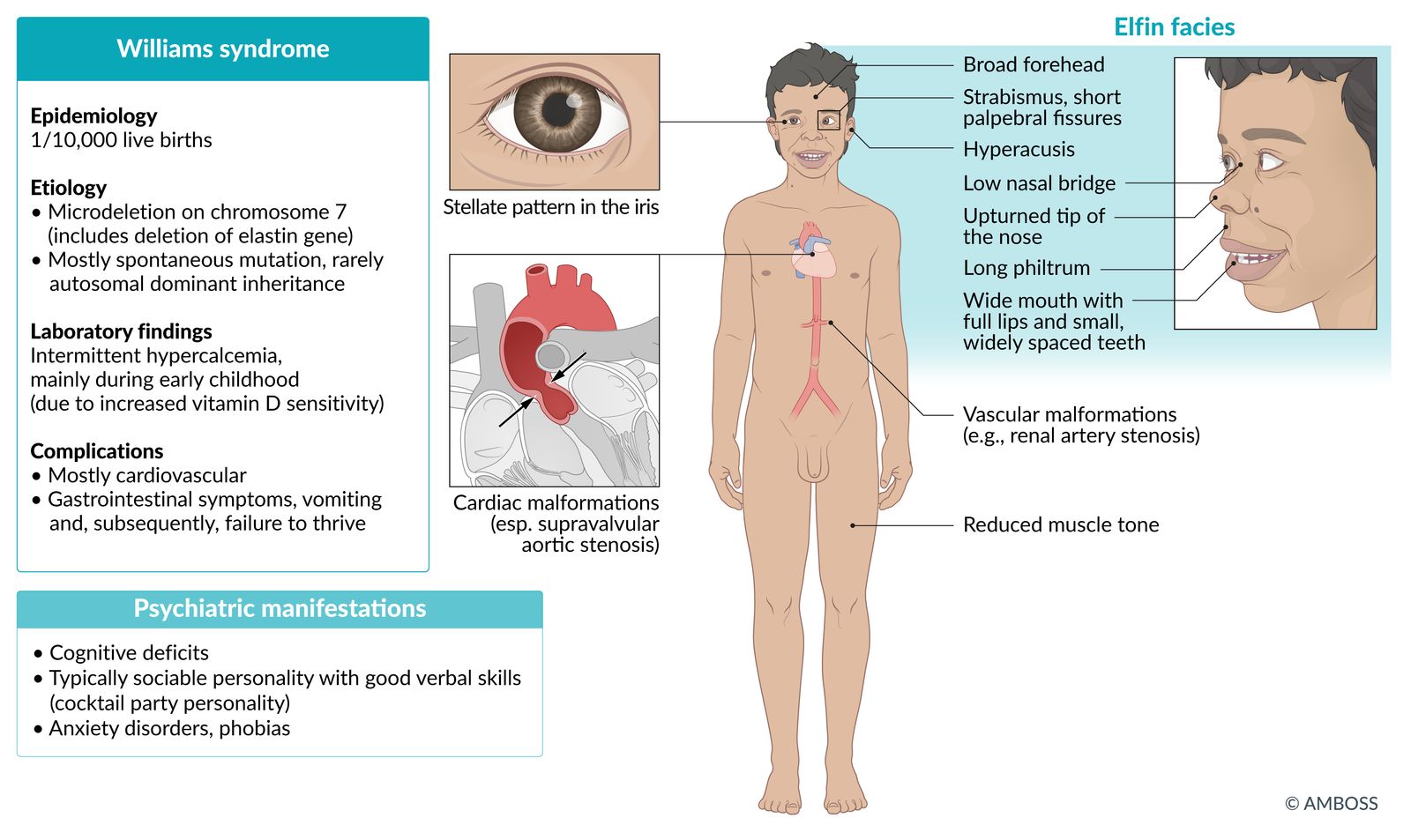 Williams syndrome fact sheet